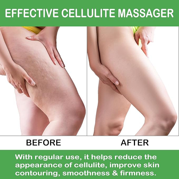 Cellulite Massage Tool Leg Roller. Lymphatic Drainage Massager Muscle Roller with Spiky Balls for Thigh Calf Arm Back Buttock. Fascia Blaster for Circulation Deep Tissue Pain Relief Recovery (Purple)